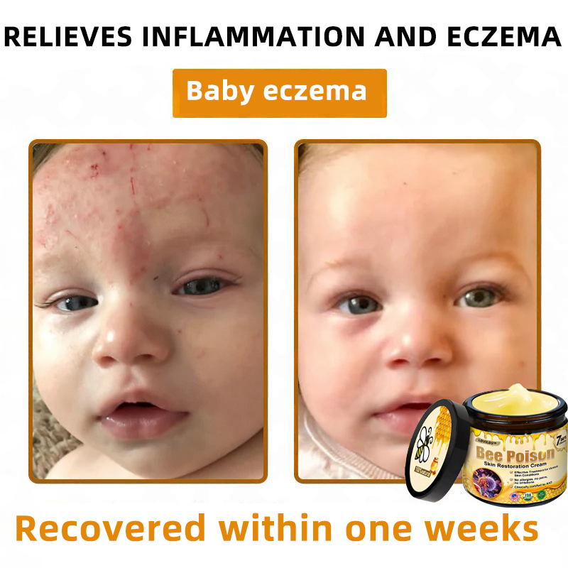 ANNRAINC™ 🐝Bee Poison Skin Restoration Cream 🐝（🔥LAST DAY SALE-80% OFF)🥇👩‍⚕️
